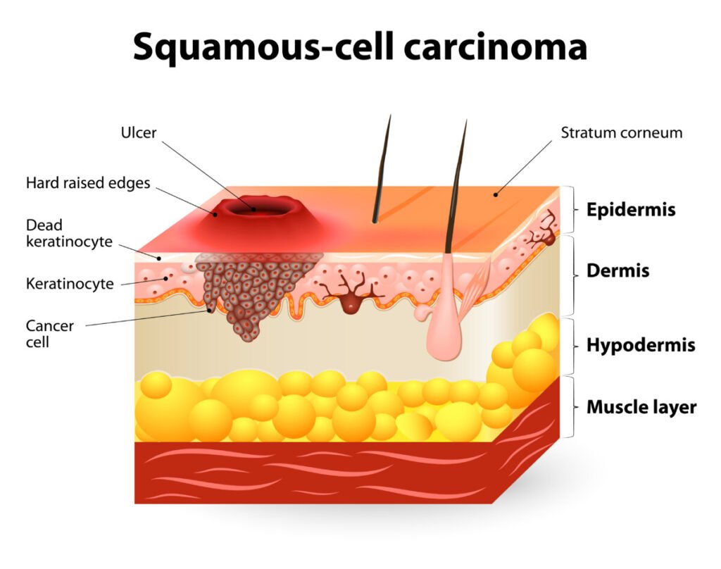 Squamous cell carcinoma guide